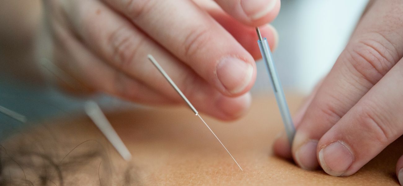 dry needling